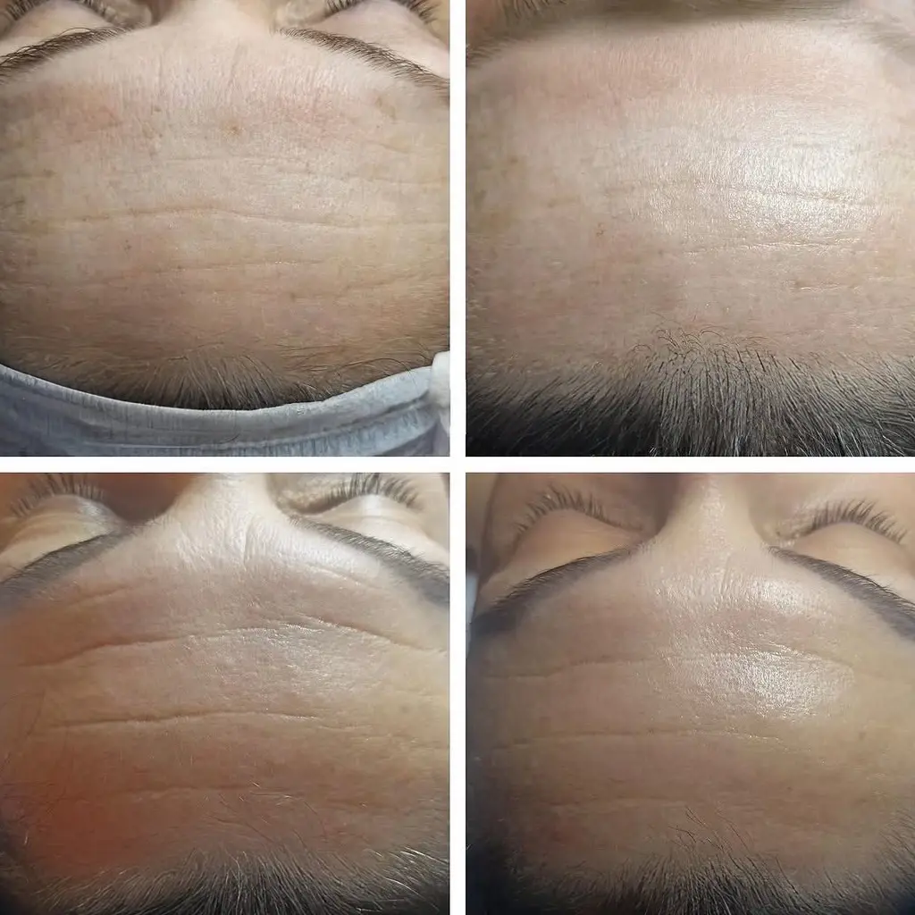 Anti Age Tretmani Protiv stareenje