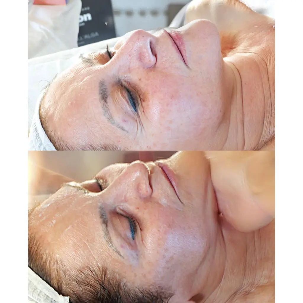 Micro Piling Tretmani Regeneracija na lice