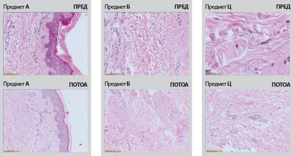 Celulit Istrazuvanje
