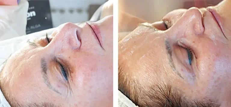 Micro Piling Tretmani Regeneracija na lice