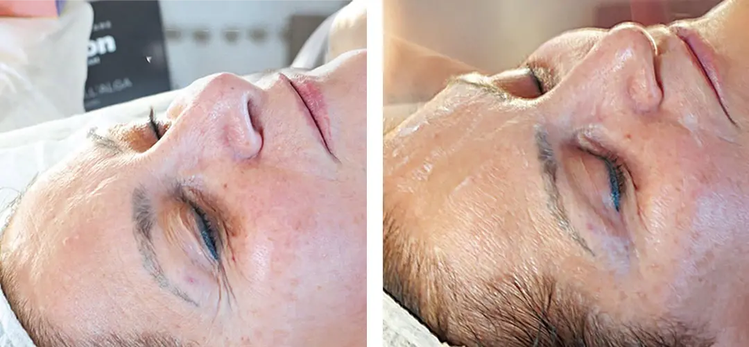 Micro Piling Tretmani Regeneracija na lice