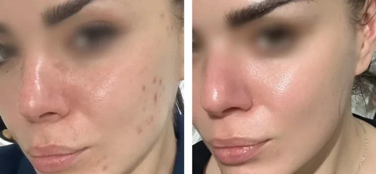 Sea Impure Tretmani Mrsna i necista koza Thumbnail